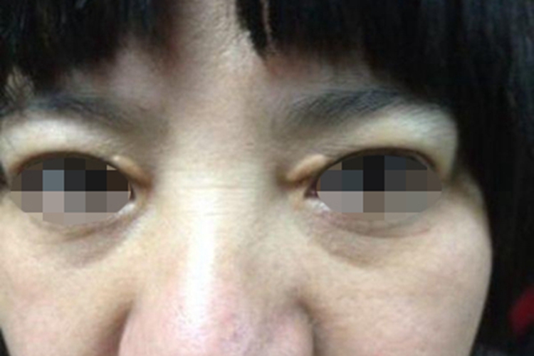 泛发性扁平黄色瘤眼睑疙瘩图