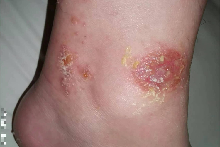 钩蚴性皮炎脚踝黄痂图