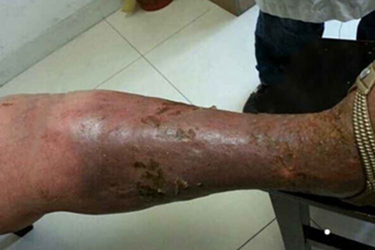 急性淋巴管炎小腿结痂图 急性淋巴管炎小腿结痂图