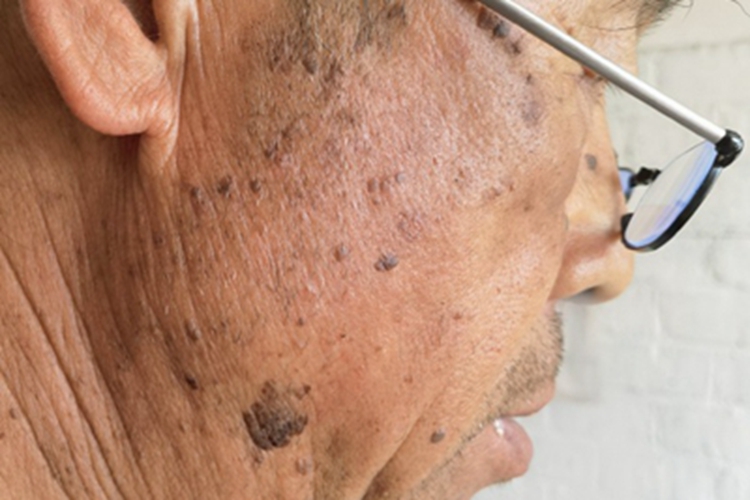 疣状脂溢性角化症面部黑斑图 疣状脂溢性角化症面部黑斑图