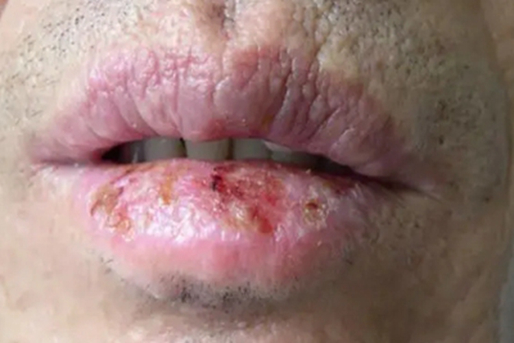 慢性唇炎下嘴唇出血结黄痂图