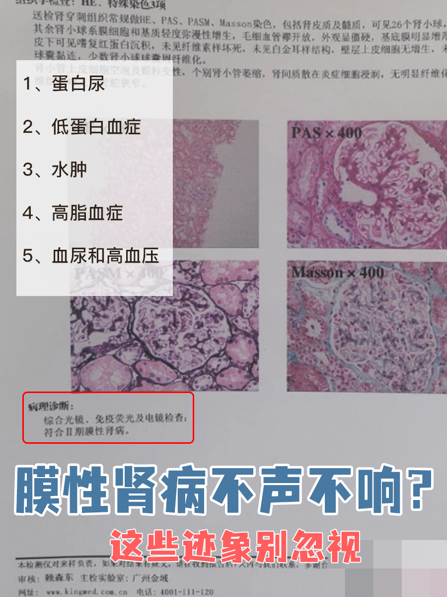 膜性肾病不声不响？这些迹象别忽视