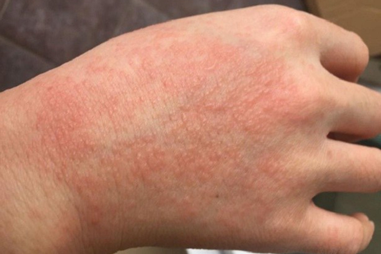 过敏性皮炎手背红斑图