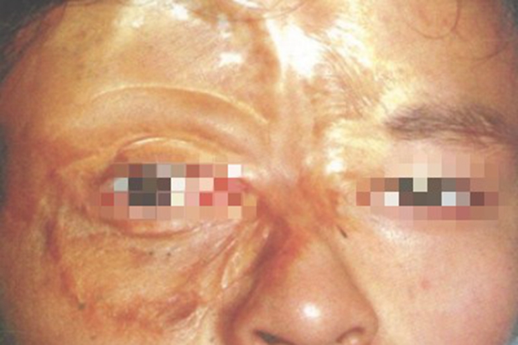 电烧伤面部瘢痕图 电烧伤面部瘢痕图