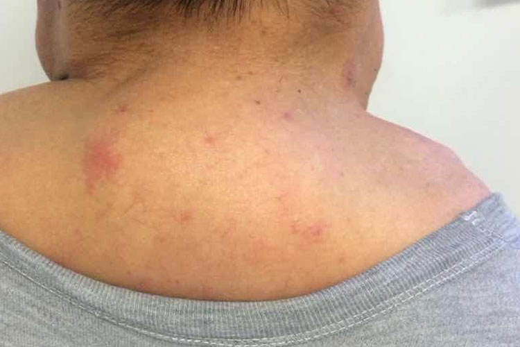 脖子上长脂肪瘤图 脖子上长脂肪瘤图