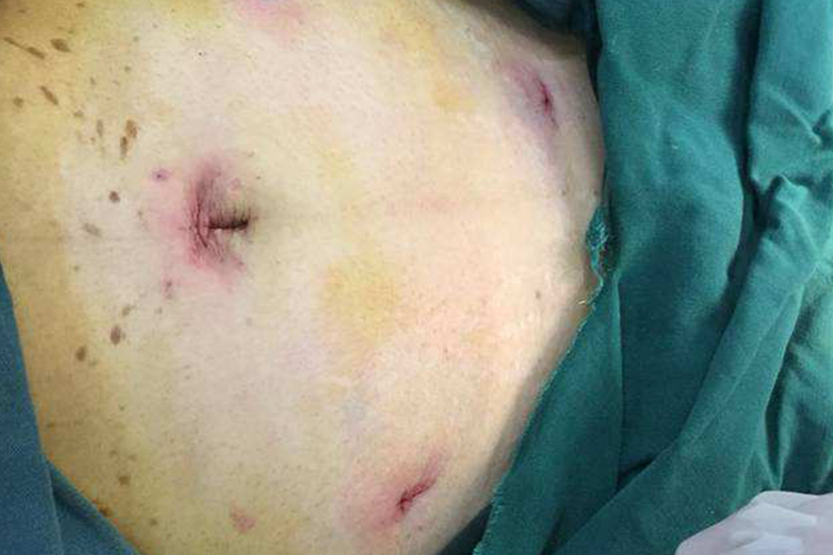 子宫肌瘤微创手术伤口图