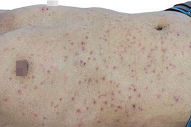 急性移植物抗宿主病腹部红点图