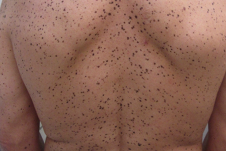 泛发性黑子病背部黑斑图 泛发性黑子病背部黑斑图