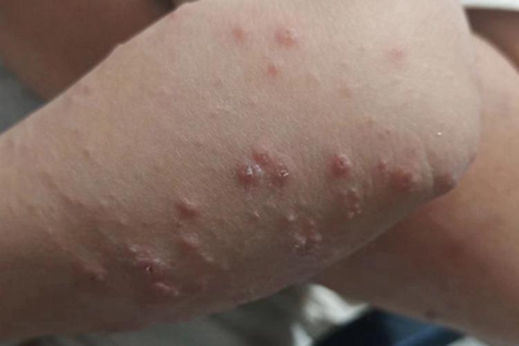 丘疹性荨麻疹结痂图