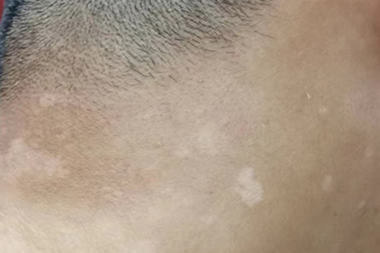 花斑糠疹脖子上长白色斑片图