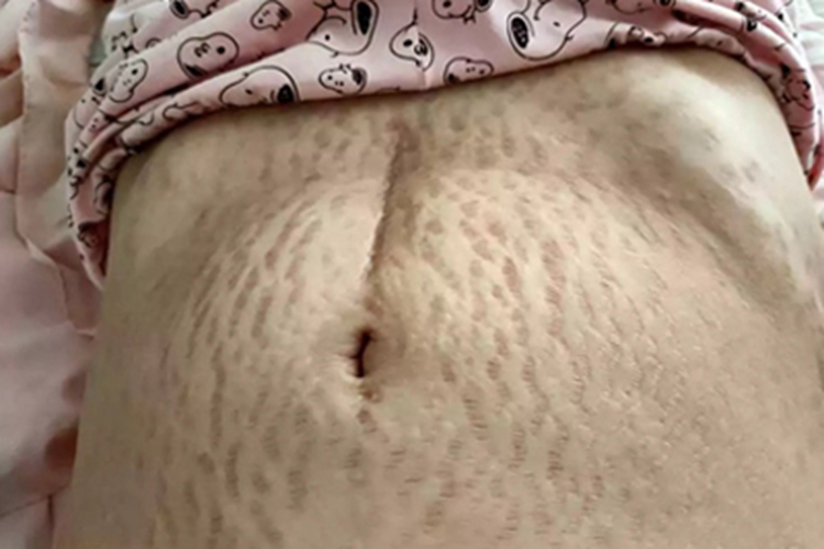 萎缩纹肚子长纹图