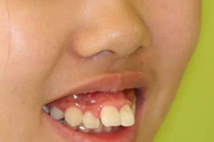 龅牙症状图 龅牙症状图