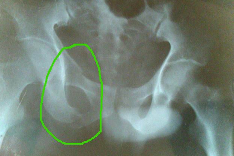 右耻骨下支骨折图