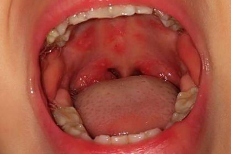手足口病初期口腔疱疹图