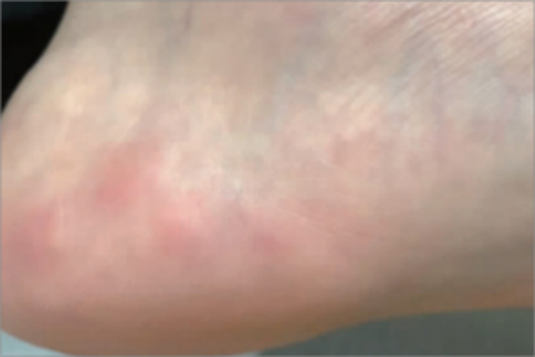 足跟压力性疼痛性丘疹脚后跟小红疙瘩图