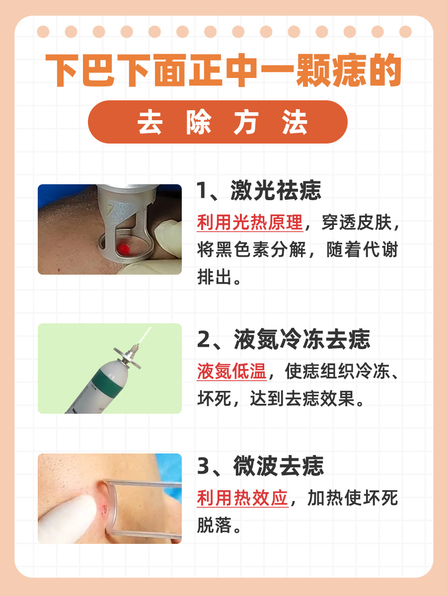 带你了解：下巴下面正中一颗痣怎么去除