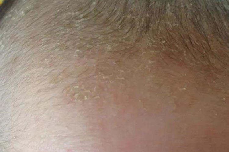 三个月宝宝头上干燥性湿疹图 三个月宝宝头上干燥性湿疹图