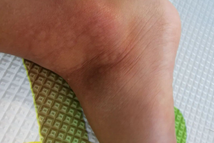 荨麻疹脚踝小红疙瘩图