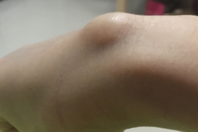 腱鞘囊肿手腕大包图