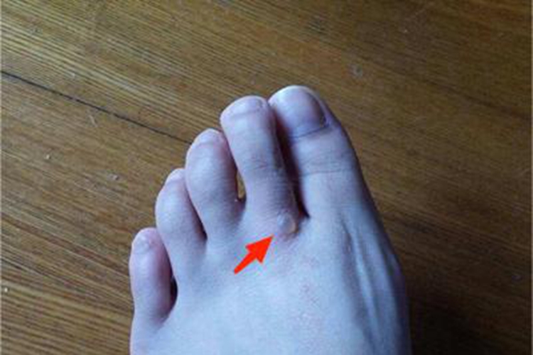 脚趾长透明水疱图