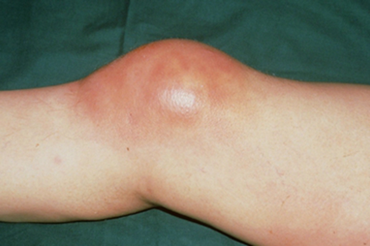 膝关节创伤性滑膜炎膝盖红肿图