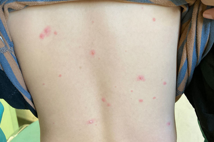 躯干部水痘图