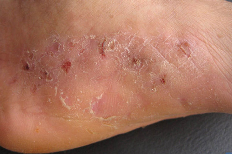 鳞屑角化型足癣图