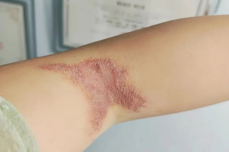 隐翅虫皮炎中期结痂图