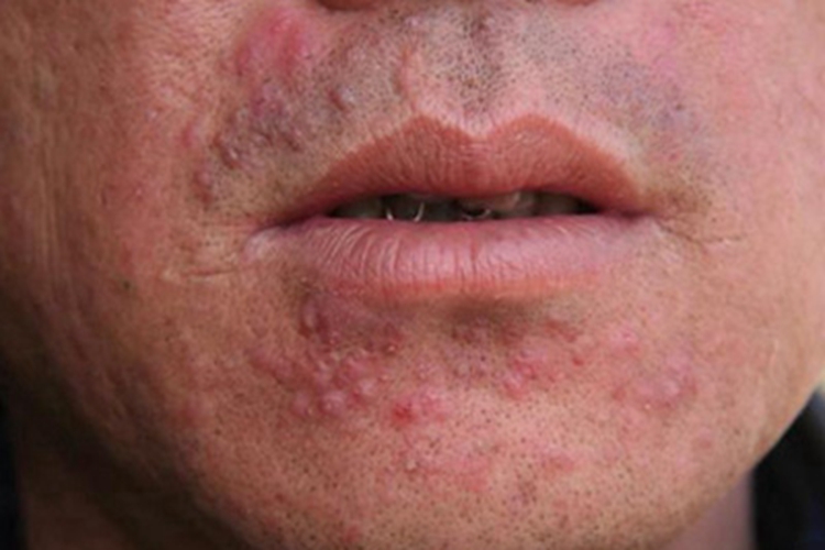 狼疮样须疮下巴丘疹症状图 狼疮样须疮下巴丘疹症状图