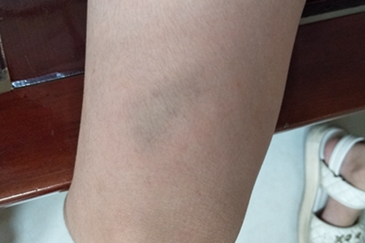 撞伤皮肤肿图 撞伤皮肤肿图