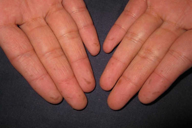 色素沉着息肉综合征手指有褐斑图