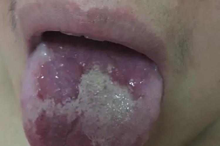 舌头扁平苔藓白色斑块图