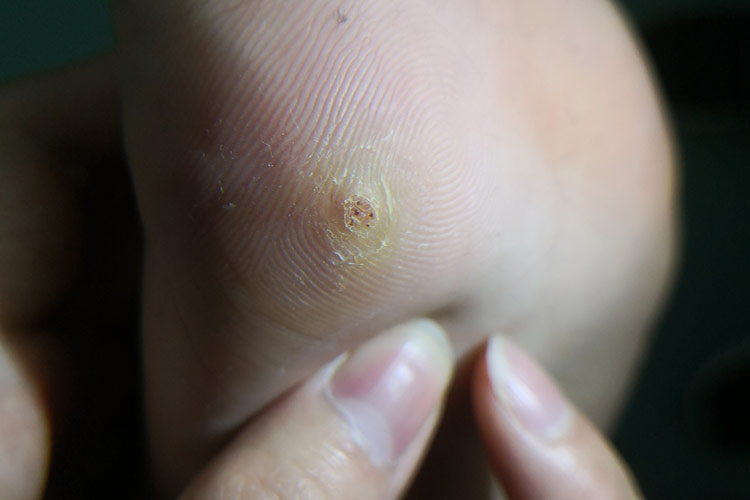 病毒性跖疣图片