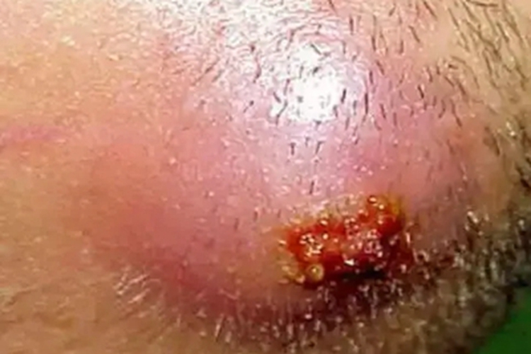 颜面疖痈下巴大红疙瘩图