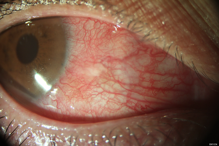 沙眼慢性期图 沙眼慢性期图