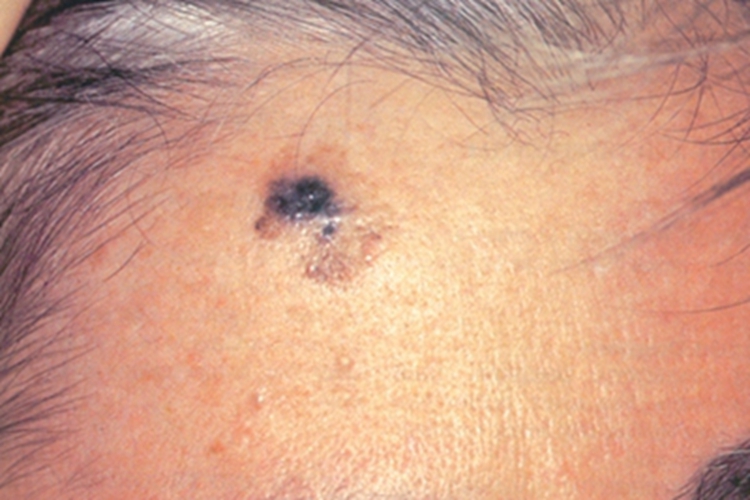 原位恶性黑色素瘤早期黑斑图