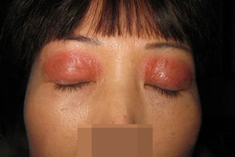 接触性皮炎眼周红肿图 接触性皮炎眼周红肿图
