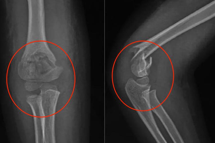 无移位型伸直型肱骨髁上骨折图