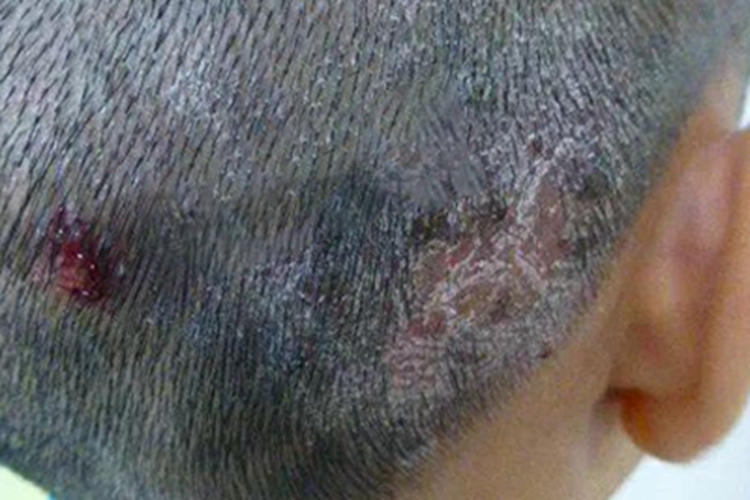 脓癣头皮有丘疹结痂图