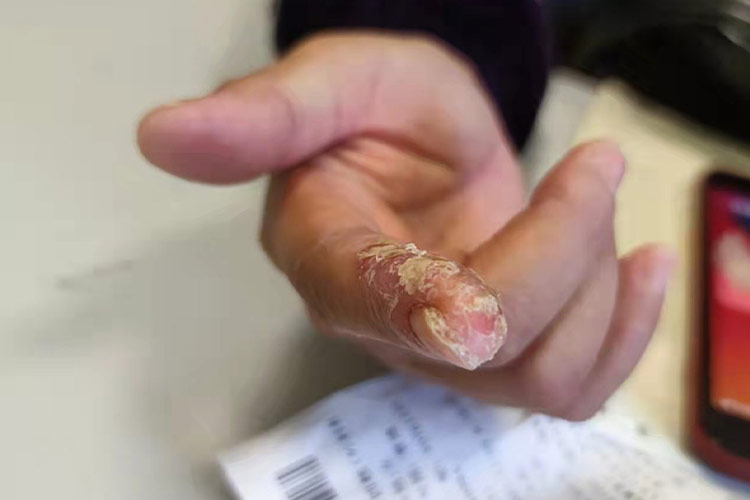 鳞屑角化型手癣图