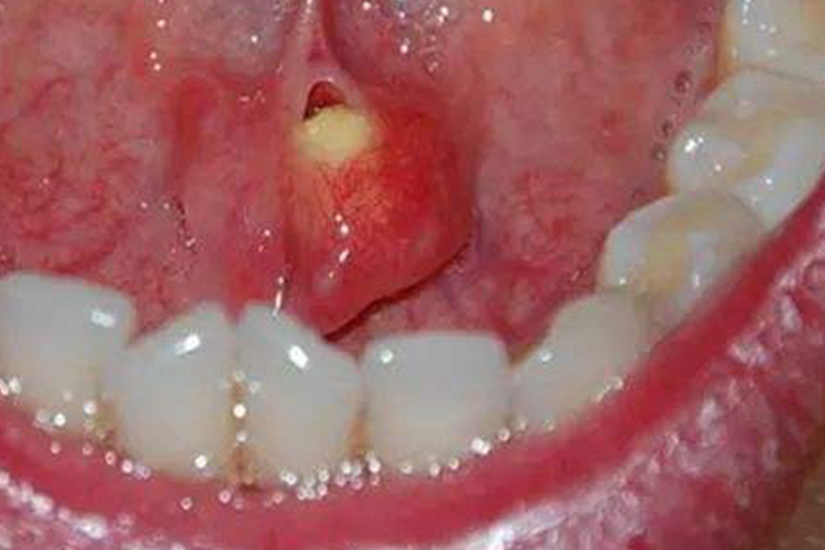 唾液腺结石病图 唾液腺结石病图