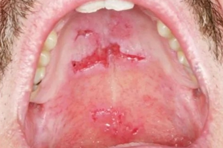 副肿瘤性天疱疮口腔糜烂图