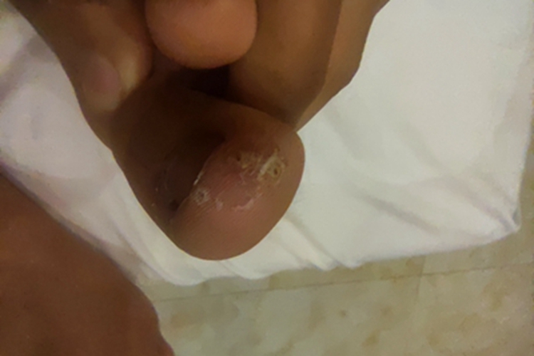 寻常疣脚趾上有丘疹和死皮图