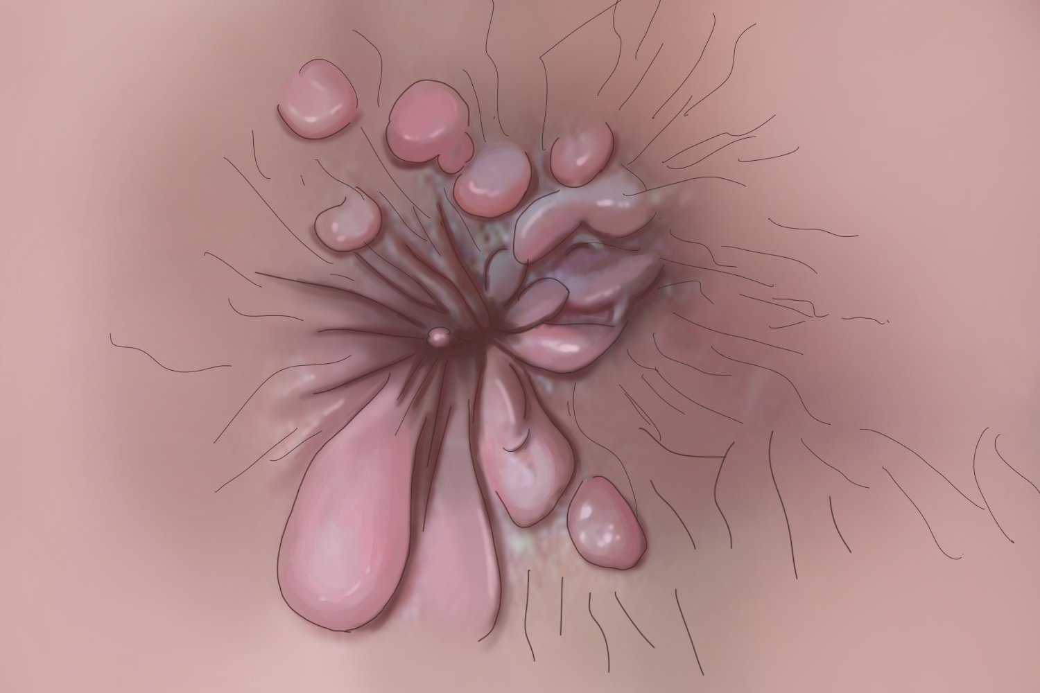 屁股上扁平湿疣图