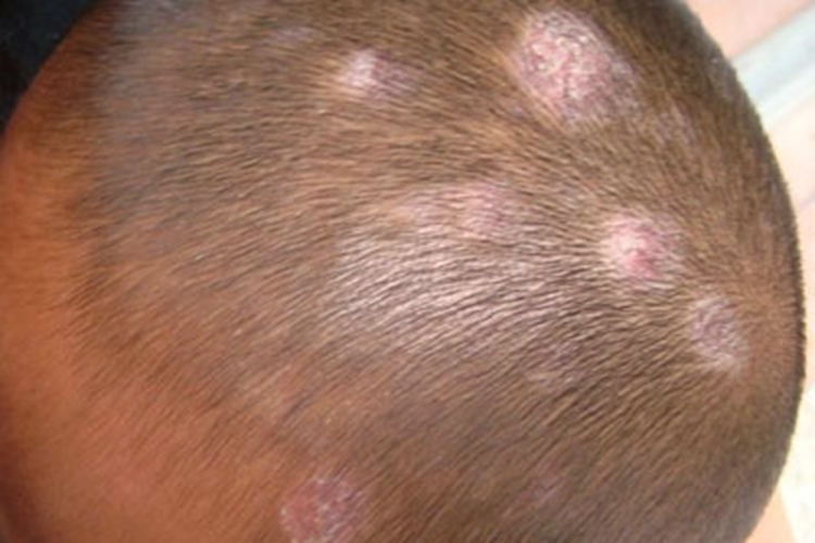 儿童白癣初期图 儿童白癣初期图