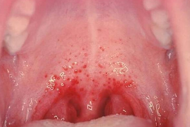 口腔上腭疱疹性咽峡炎图