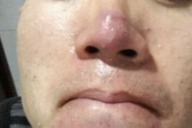 鼻赘型酒糟鼻鼻部红肿图