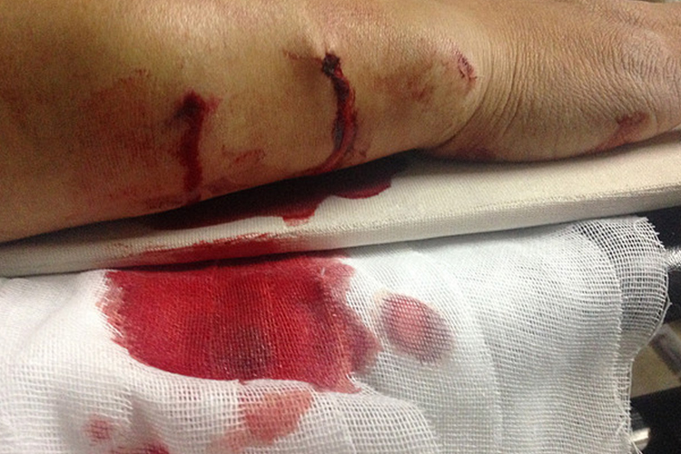 第一度开放性骨折图