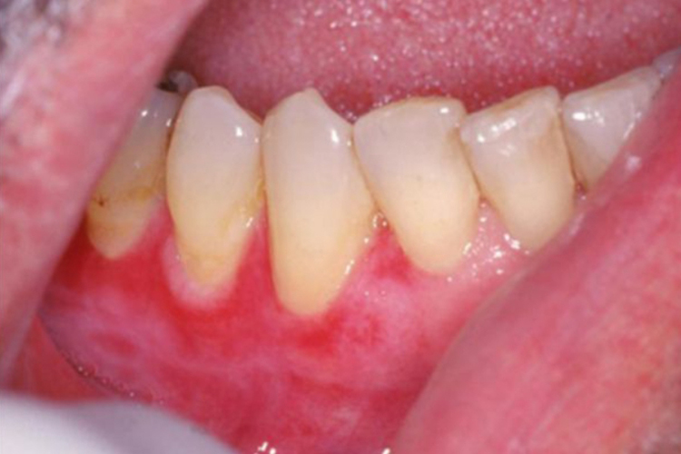 牙龈扁平苔藓症状图