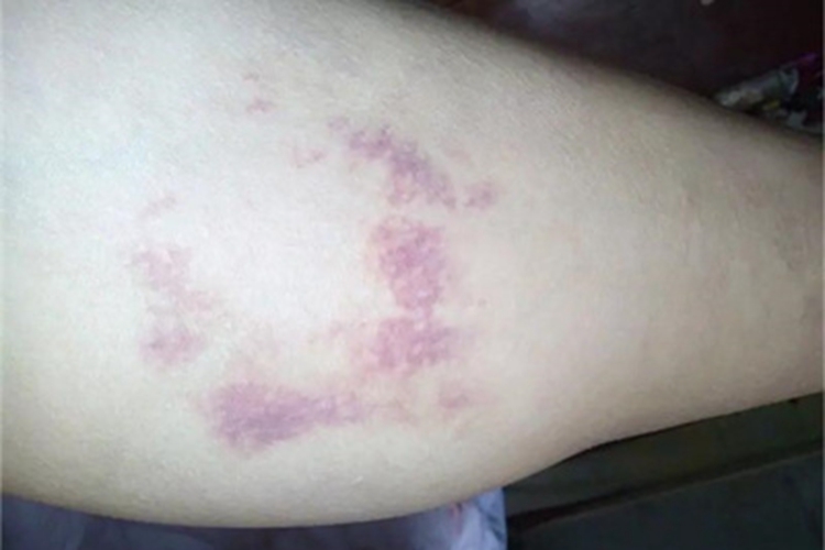 色素性紫癜性皮疹小腿紫斑图